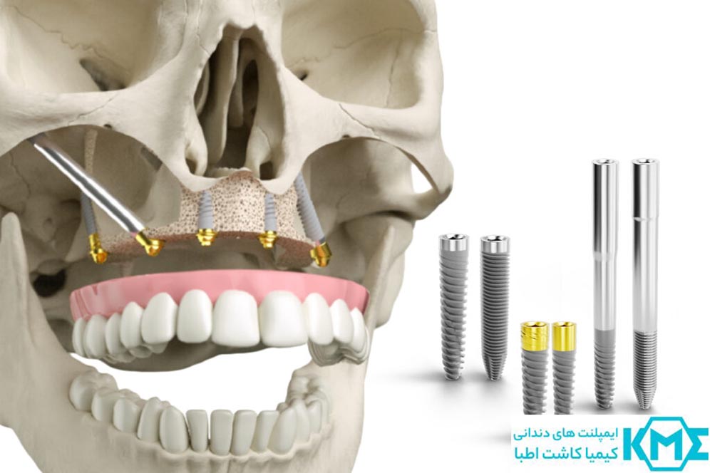 ایمپلنت فک بالا