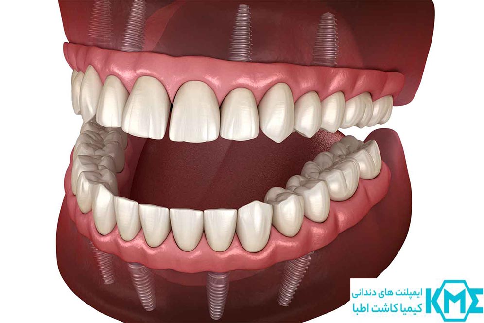 ایمپلنت فک بالا