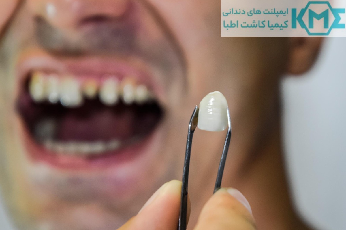 دندان چسبی بهتر است یا ایمپلنت
