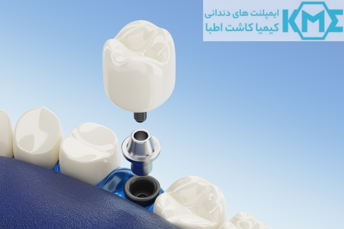 دندان چسبی بهتر است یا ایمپلنت
