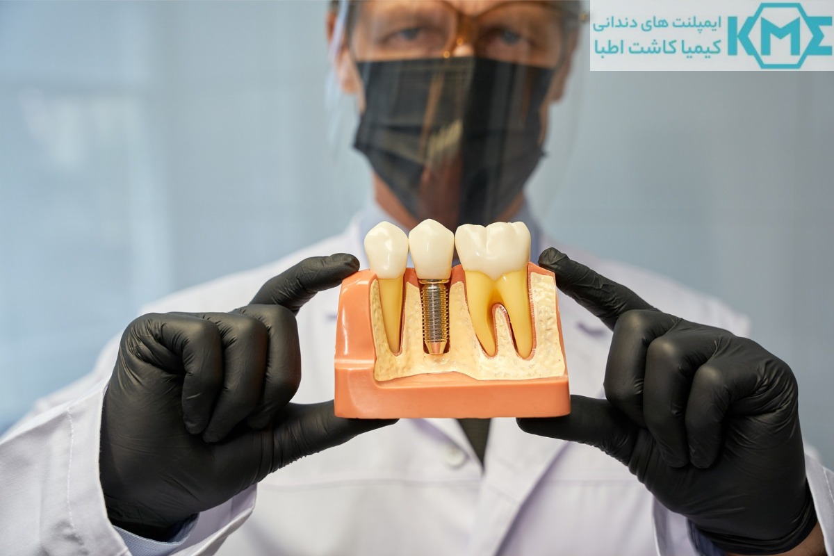دندان چسبی بهتر است یا ایمپلنت