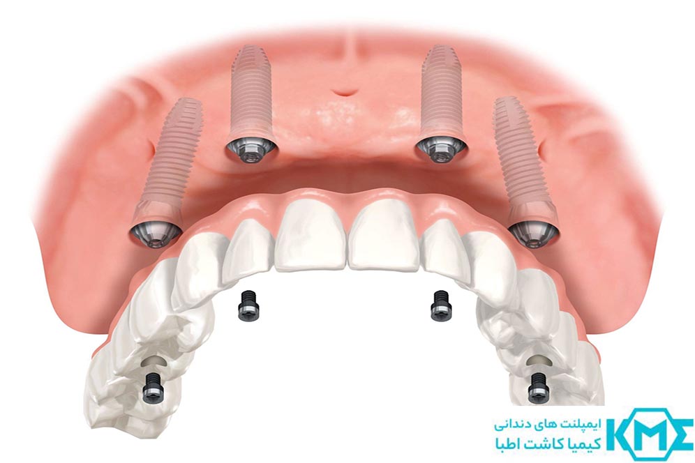 ایمپلنت فک بالا